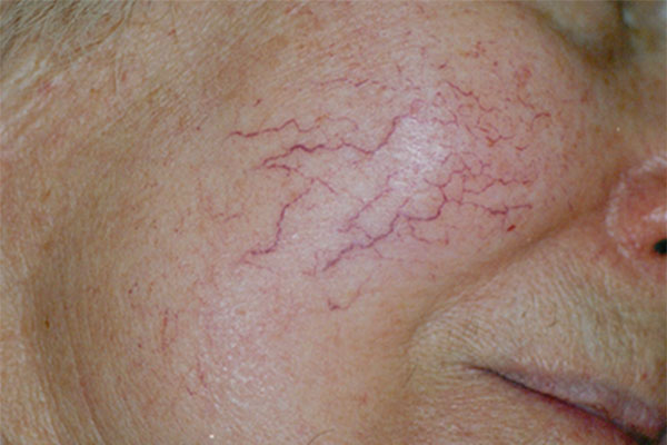 Laser treatment for facial thread vein