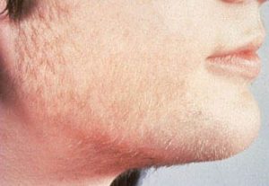 Image of lady who has pcos with facial hair around her chin and cheeks