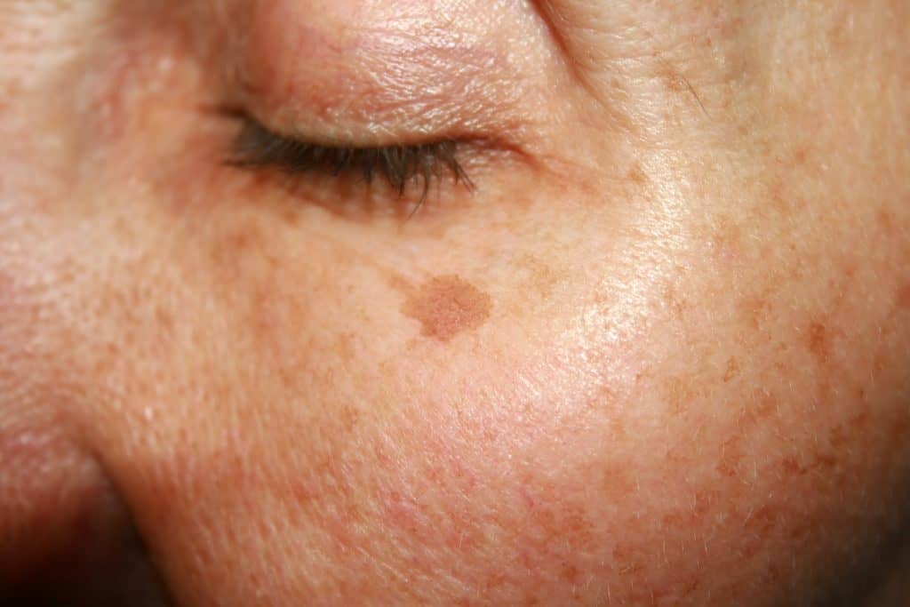 image of woman with sunspot on her cheek